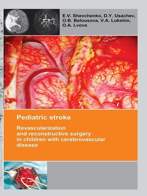 cover image of Pediatric stroke. Revascularization and reconstructive surgery in children with cerebrovascular disease